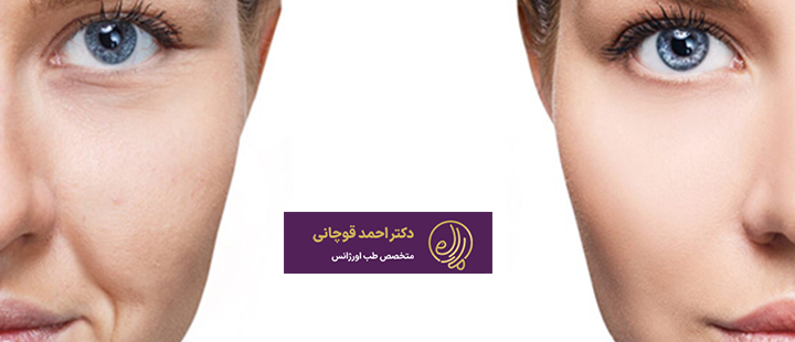 تزریق چربی به صورت چگونه است؟
