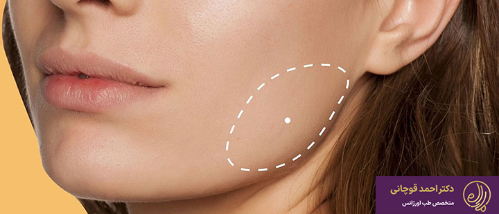 جراحی بوکال فت چیست؟