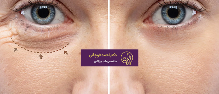 جراحی پلک