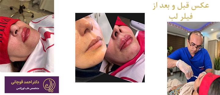 عکس قبل و بعد از فیلر لب 