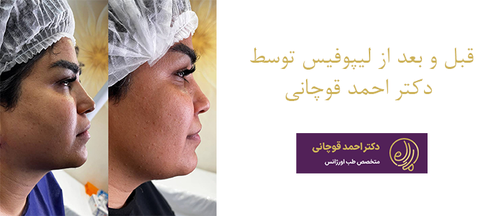 قبل و بعد از لیپوفیس 