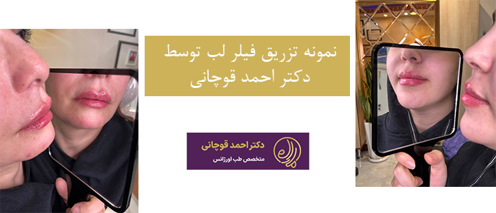 نمونه تزریق فیلر لب توسط دکتر قوچانی 