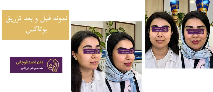 نمونه قبل و بعد تزریق بوتاکس 