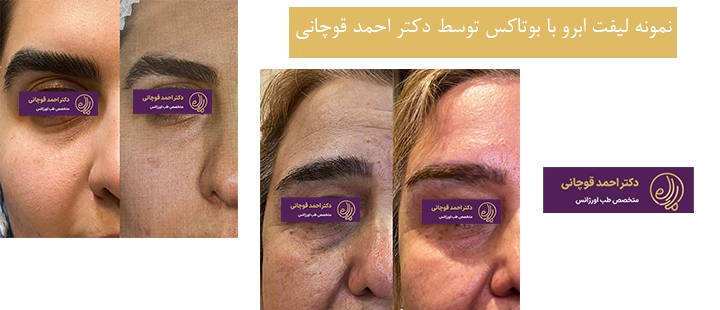 نمونه لیفت ابرو با بوتاکس 