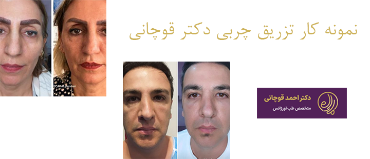 نمونه کار تزریق چربی دکتر قوچانی 