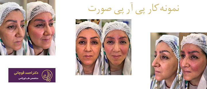 نمونه کار پی آر پی صورت 