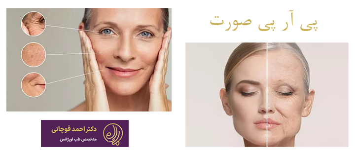 پی آر پی صورت چیست؟