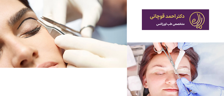 آشنایی با مراقبت های پس از بلفاروپلاستی