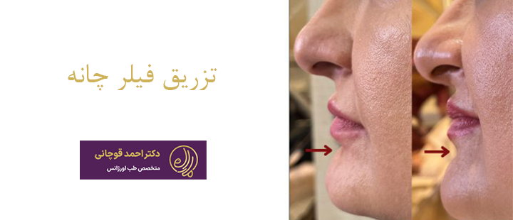 تزریق فیلر چانه چیست؟