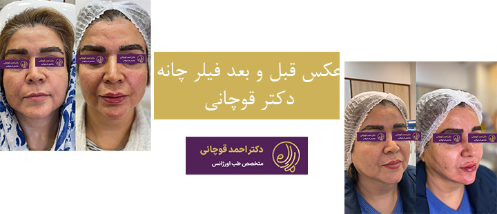 عکس قبل و بعد فیلر چانه دکتر  قوچانی 