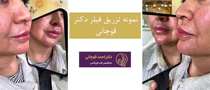 نمونه تزریق فیلر دکتر قوچانی 