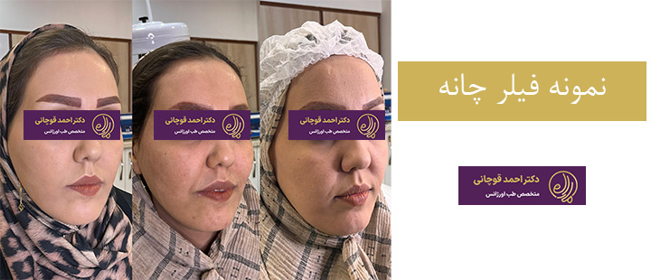 نمونه فیلر چانه 