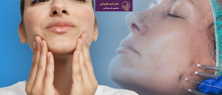 درباره ماندگاری لیفت صورت با نخ 