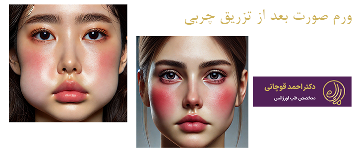 درباره ورم صورت بعد از تزریق چربی 
