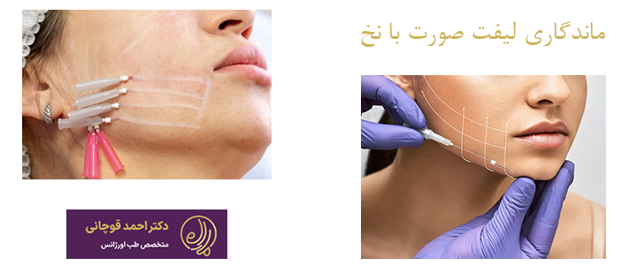 ماندگاری لیفت صورت با نخ چقدر است؟