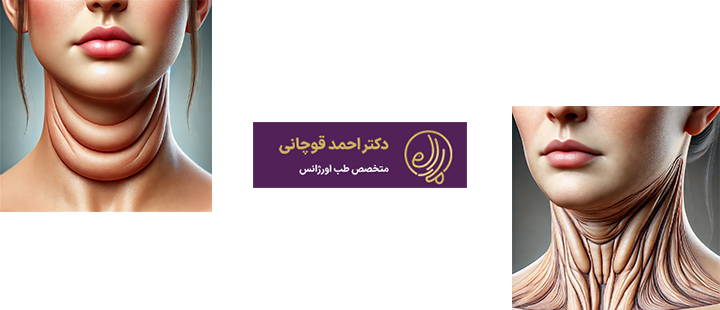 آشنایی با شل شدن پوست بعد از ساکشن غبغب 