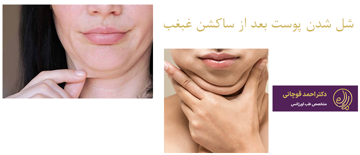 درباره شل شدن پوست بعد از ساکشن غبغب 