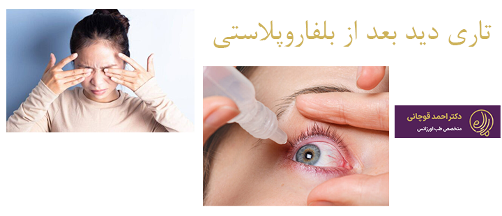درباره تاری دید بعد از بلفاروپلاستی 