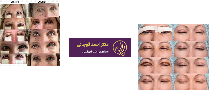 علت ورم پلک بعد از بلفاروپلاستی 