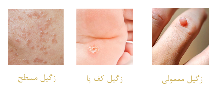 انواع زگیل 