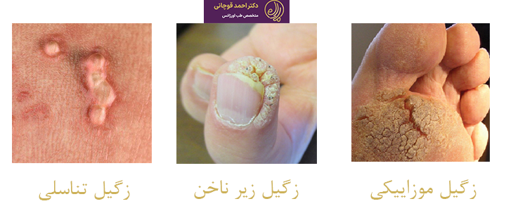 زگیل تناسلی چه انواعی دارد؟