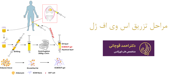 مراحل تزریق اس وی اف ژل 