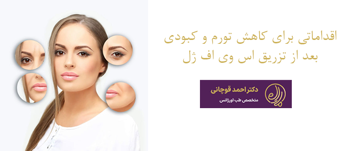 اقداماتی برای کاهش تورم و کبودی  بعد از تزریق اس وی اف ژل 