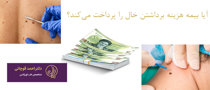 آیا بیمه هزینه برداشتن خال را پرداخت می‌کند؟