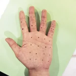 بوتاکس کف دست
