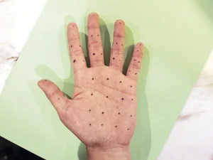 بوتاکس کف دست