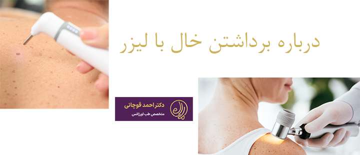 درباره برداشتن خال با لیزر 