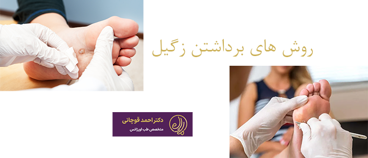 روش های برداشتن زگیل 