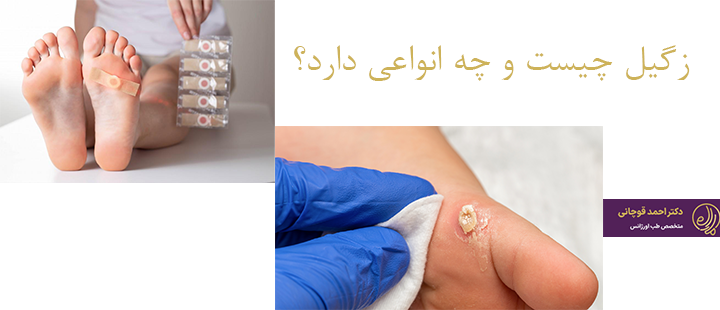 زگیل چیست و  چه انواعی دارد؟