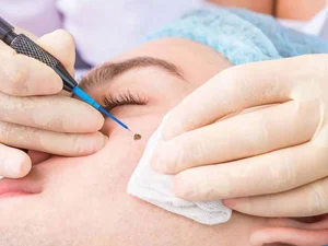 مراقبت‌ های بعد از برداشتن خال