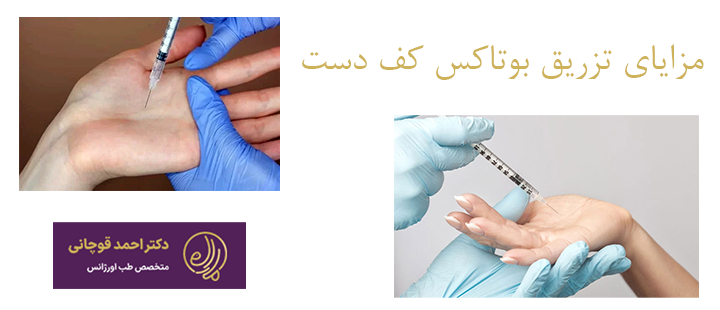 مزایای تزریق بوتاکس کف دست