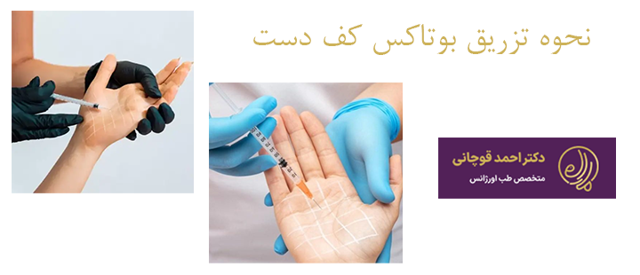 نحوه تزریق بوتاکس کف دست 