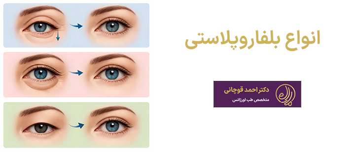 انواع بلفاروپلاستی