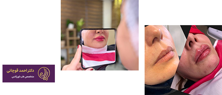 فیلر دکتر قوچانی