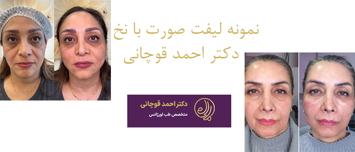 نمونه کار لیفت صورت دکتر قوچانی 