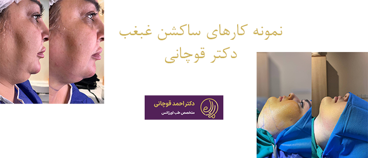 نمونه کارهای ساکشن غبغب دکتر قوچانی 