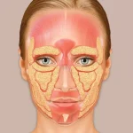 درباره سندرم پرشدگی صورت