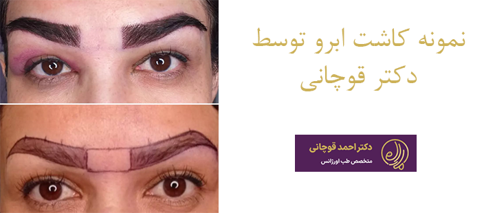 نمونه کاشت ابرو توسط دکتر قوچانی 