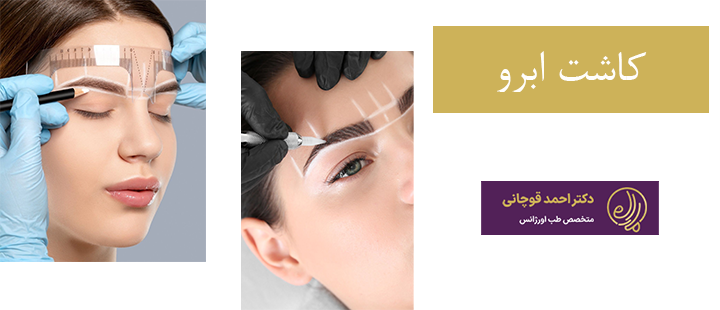 کاشت ابرو چیست؟