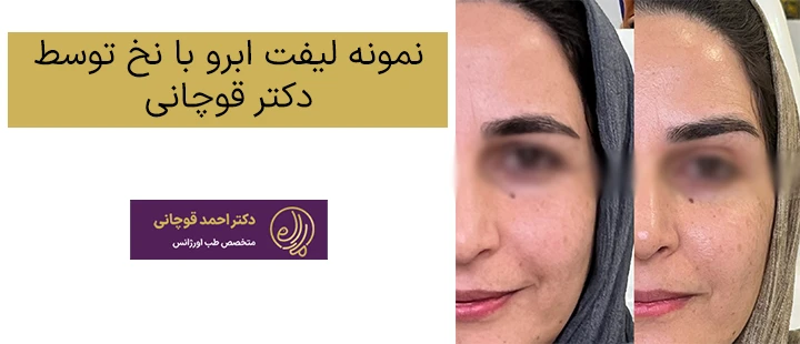 نمونه لیفت ابرو با نخ توسط دکتر قوچانی