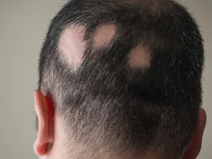 ریزش موی سکه ای