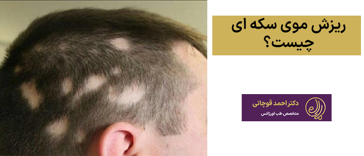 ریزش موی سکه ای چیست؟