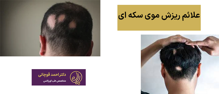 علائم ریزش موی سکه ای
